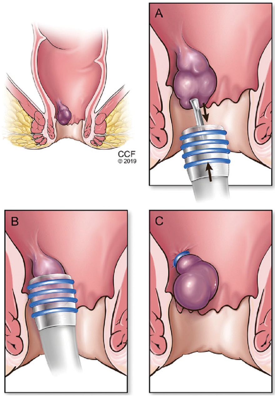 how to cure hemorrhoids